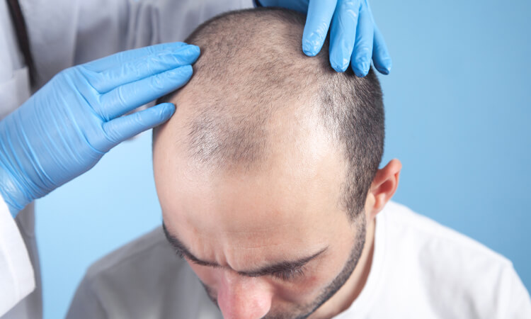 Cancellation Cost of Hair Transplant Procedure