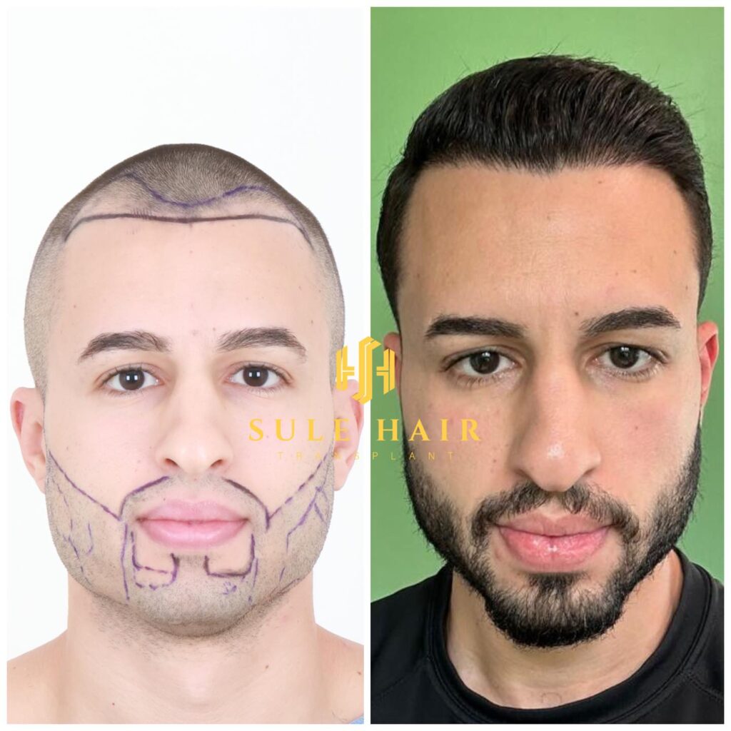 Combination Surgeries: Hair and Beard Transplant Cost