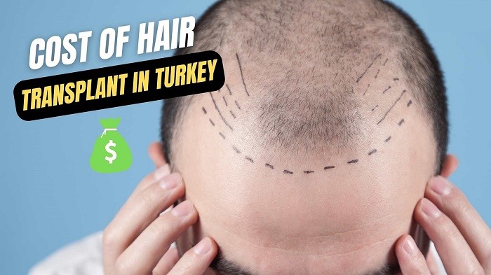 Cost of Spending 2 Days in Turkey During Hair Transplant Procedure