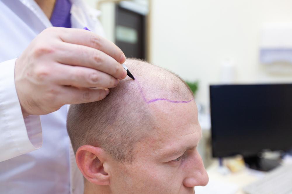 Factors That Should Not Increase The Cost Of Hair Transplant