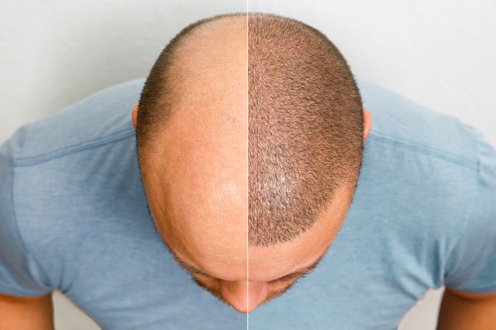How much does hairline surgery cost? Pattern baldness or androgenetic alopecia is a permanent condition. It affects both males and females. In men, the hormone dihydrotestosterone (DHT) is a major source of hair loss. But it can happen due to a combination of environmental, genetic and hormonal factors. Many women start experiencing signs of pattern baldness after menopause. This could indicate a relationship between hormone levels and hair growth. When over-the-counter remedies for hair loss fail, many people start looking for other treatments, such as PRP therapy or hair transplant. However, the expenses of such procedures remain an important concern. This guide will outline the factors that determine hairline surgery cost. In males, signs of pattern baldness start showing during puberty. The hormone DHT affects the normal hair growth cycle. Anagen phase (growth) continues to decrease while the telogen phase (resting) continues to increase. This makes the hair weak and prone to breakage. Meanwhile, the size of follicles continues to shrink, also known as miniaturization. It produces thin, vellus hair, in contrast to terminal hair. How Pattern Baldness Proceeds? Both the genders will observe a thinning of their hair in this condition. If your hair has started to fall out of the blue, then you need to immediately consult a doctor. It might be some other condition such as alopecia areata, fungal infection, nutritional deficiency or hormonal imbalance. In males, the thinning begins at the crown and the temples. You will soon start to see an “M” shape at the hairline. It is a clear sign of pattern baldness. With time, you will continue to lose your hair. Eventually, you’ll start seeing a clear bald spot at the vertex or centre of your scalp. Mostly, the hair will be left on the back and sides of the head. The presence of these hair makes hair transplant possible. They act as the donor area. To determine pattern baldness in females, usually, the Ludwig classification system is used. In this study, the evolution of hair loss was observed in 468 female participants. In Type I, hair starts to thin at the crown. Many women try to hide their signs of hair loss by styling their hair in a manner that can camouflage the balding spot. Type II is marked by an increasing loss of hair. Women can see their scalp at this point. In Type III, the crown goes completely bald. However, it is rare for women to completely lose her hair. Ebling and Rook made some slight changes to this model. Unlike in Ludwig classification, they show that the hairline of women can also recede as in males. Further researches showed that when you part the centre of the head, the hair density decreases in a “Christmas tree” pattern. This is also indicative of pattern baldness. If you think that you have all these signs of hair loss, then you should get in touch with a professional. They’ll give you a proper diagnosis. You can use some medications as a solution, but they will be temporary. Your hair is likely to fall out as soon as you stop using them. For a receding hairline, it is better that you choose a permanent surgery option. You can find out what affects the hairline surgery cost in the following section. Factors Affecting Your Hairline Surgery You can achieve two kinds of hairlines through a hairline transplant surgery: V shape or straight. The former is quite popular among Afro-Americans. Many want to achieve this. With a hairline transplant, there are high chances of attaining one. It differs from a normal procedure in that it requires fewer grafts. However, to choose between the two, you need to consult a professional surgeon. The following factors will affect hairline surgery cost. The Shape of your Face A facial attraction has persisted for ages. Evolution might make certain faces more attractive to us than the others. However, it was the Ancient Greeks who developed the idea of a golden ratio of 1:1.618. To measure this, you can divide the length of your face with its width. If the answer’s 1.618, then it indicates a golden ratio symmetry. The length of the face would start from the hairline, which is why a proper one must be drawn. If there’s an error in this the hairline, it might start to look artificial and fake. The application of the golden ratio is common in many clinical surgeries. Muscles on Your Forehead Sometimes patients want to have a lower hairline. However, they need to remember that no way the insertion of grafts can take place in muscles. There are muscles on our forehead, which help with facial movements. They won’t support the growth of your hair in any way. Proper placements of grafts are important for seeing any results. Your transplantation surgery won’t be possible otherwise. What Your Age Is The positioning of your hairline will be determined according to your age. As a person gets older, their skin starts to sag due to decreasing collagen. So, your forehead will move forward. Keeping this in view, people have to choose a higher airline. It might start to look extremely odd otherwise. All these factors will collectively determine the number of grafts that you’ll be needing. This has a direct bearing on the cost of hairline surgery. A transplantation surgery will offer you a lifetime solution for hair fall. Moreover, there are many other benefits to it. Benefits of Having a Hairline Surgery Many misconceptions surround hairline transplant surgery. They might hamper you from getting your desired procedure. By reading the following, you’ll realise that choosing a transplantation surgery is much more effective and cost-efficient. Hairline Transplant Surgery is Affordable It is true that in many countries you cannot find a cheap hair transplant package. Getting quality surgery can alone cost you £10,000 in the UK. This certainly makes the procedure inaccessible to many. However, the medical tourism industry of countries such as Turkey has made it a possibility for almost anyone. For less than £1,500 you can achieve the same results but for much less price. You’ll find that many tourists there have their heads bandaged. It is that common. To ensure the safety of the patients, the government has also taken a lot of steps. The American Hair Loss Association has stated that, according to The Washington Post, more than $3.5 billion are spent by hair loss sufferers each year in America. If you calculate the cost of these products for a lifetime, you can probably get about more than 10 transplant surgeries in Turkey. It’s a Time-Saving Hair Loss Treatment Many people get worried about the post-op recovery period of hair transplant. They believe it can take months and months, and this will negatively impact their professional lives. This is not true. It takes only 2 days for people to get a transplantation surgery. Some people return to their work soon after the procedure. It’s just a one-time, permanent surgery. After this, you won’t be spending hours and hours applying products on your hair. It’s Painless and Scarless You will be given local anaesthesia during the surgery. However, there is a high possibility that you’ll feel pain in the post-op recovery period. It doesn’t last for more than 3-4 days, though. In any case, many clinics provide the necessary medications, including painkillers, to their patients so that they don’t have any problem. As far as the scarring is concerned, it used to be a big concern in the 90s as Follicular Unit Transplant (FUT) method was used at that time. However, Follicular Unit Extraction (FUE) technique has largely dealt with this complaint. This way, you can have natural-looking results. You’ll Find Bespoke Package Plans Hair transplant clinics understand that each patient has different needs, which is why they offer custom package plans. You can add in a cosmetic procedure with your hairline transplant. Moreover, many have travel agents who will help you plan your itinerary on days most suitable to you. You will also find that you can make payments in multiple ways. It’s better if you don’t carry a lot of cash in big cities of Turkey like Istanbul as it can put you at risk. Moreover, after you’ve had your surgery make sure that the clinics offer aftercare services. It can take almost a year to see the full results of a normal hair transplant procedure. So, a professional should be there to help you if anything comes up. Concluding Remarks As far as the price is concerned, usually the hairline surgery will cost you the same as a normal hair transplant procedure. If you find a clinic in which hairline surgery is cheaper, then they have a higher cost of their normal procedure. This compensates for the lower charges. Both procedures employ the same technique, which is why there’s no cost difference. If you think you’re losing hair while your hairline keeps pushing back, then get in touch with clinics to find a suitable hairline surgery cost package.